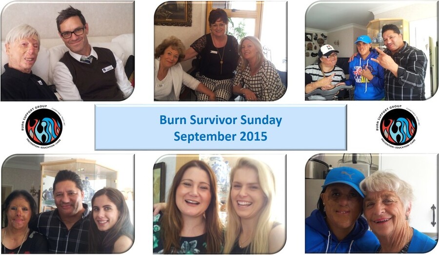 Burn Survivor Sunday